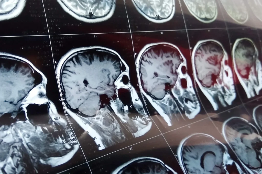 Brain scans.